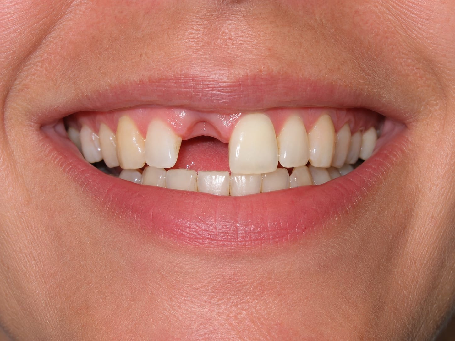 A smile with a missing tooth gap restored by a dental bridge