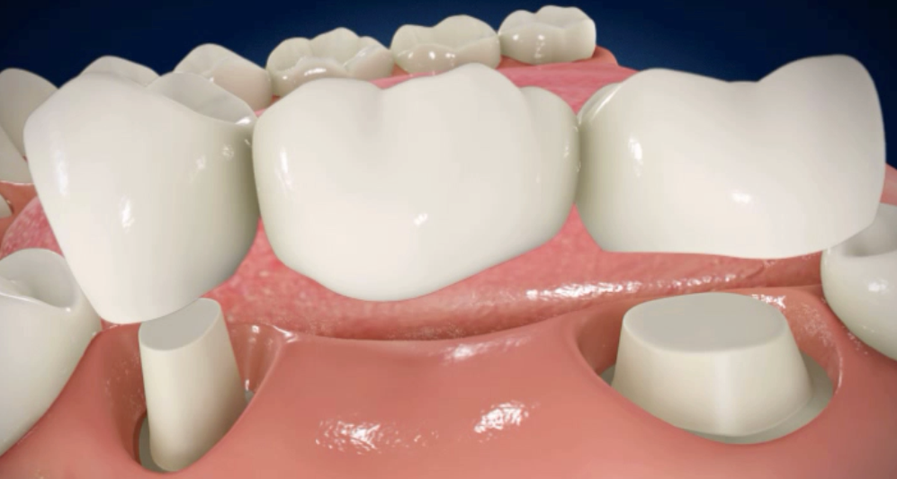 dental bridges