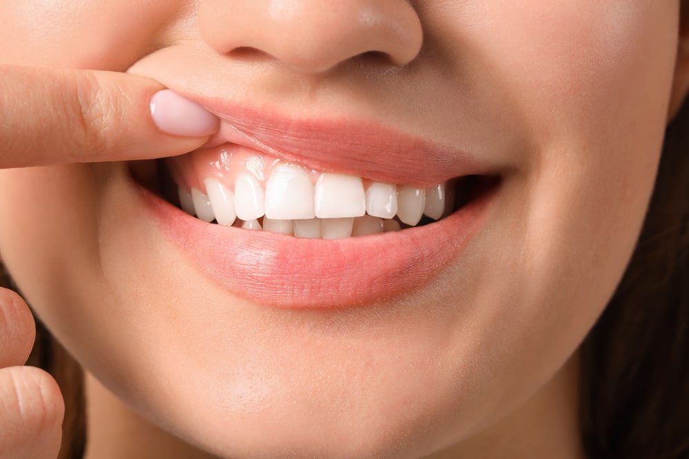 dental cleaning