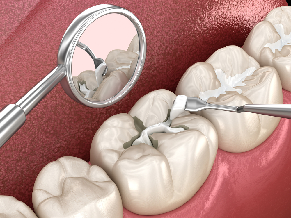 dental filling